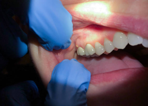Best Emergency Treatment for Dental Infections or Abscesses in Greenwood, IN